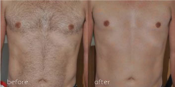before and after intense pulsed light hair removal