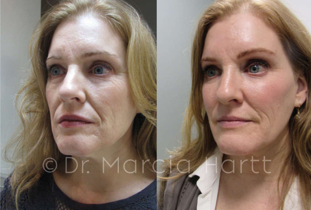 before and after cheek lift treatment