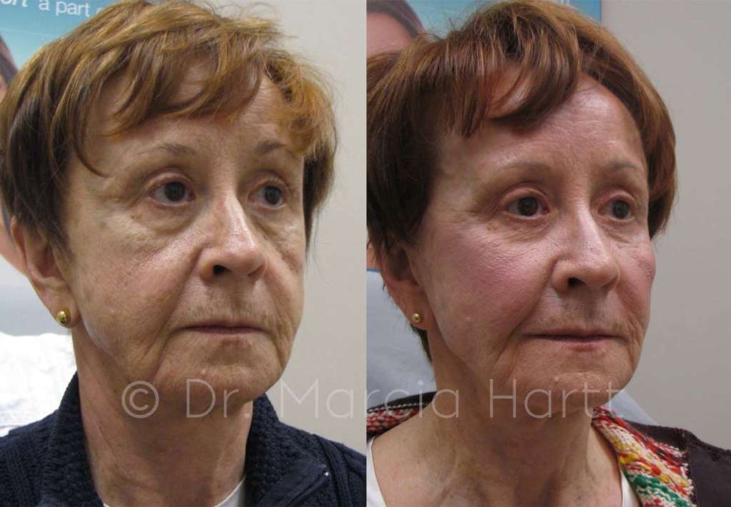 before and after cheek lift treatment