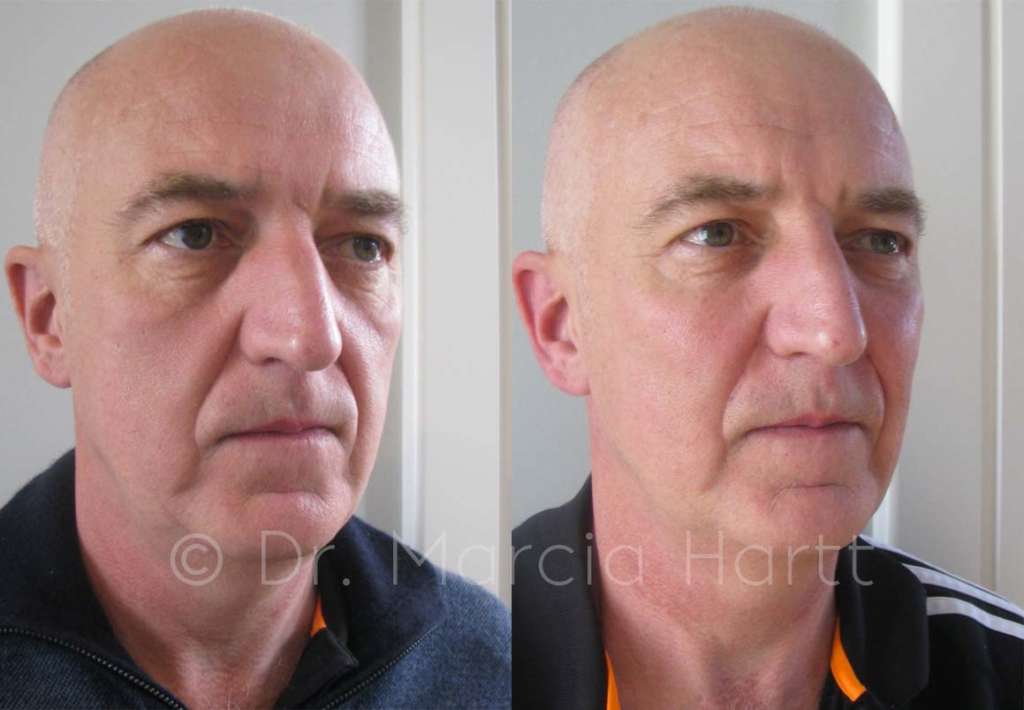before and after male cheek trough treatment