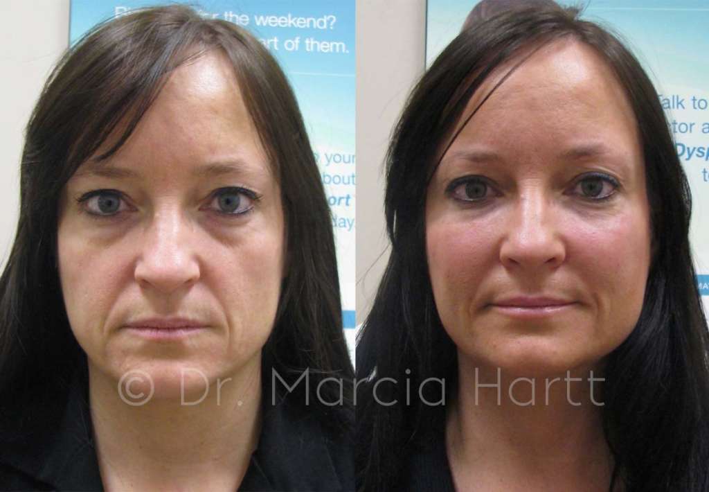 before and after non surgical face lift
