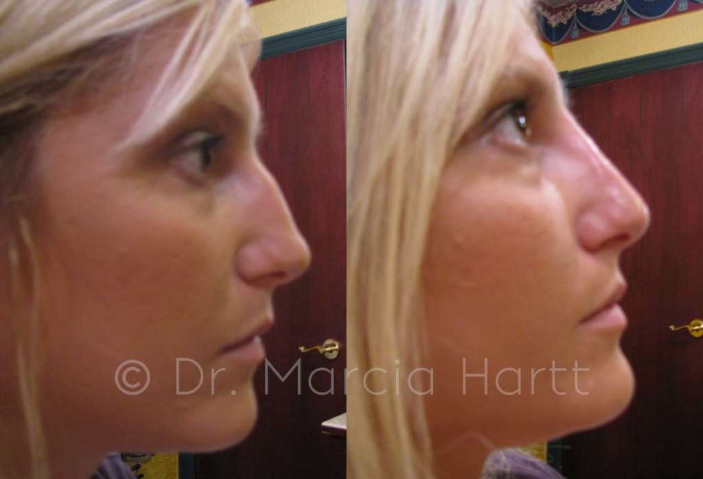 before and after non surgical rhinoplasty
