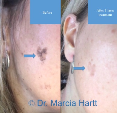 Results showing faded age spots following laser treatment by Dr. Marcia Hartt