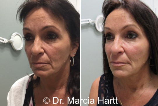 Before and after image showing anti-aging skin volume treatment by Dr. Marcia Hartt