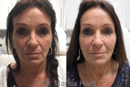 Before and After showing results of anti-aging volume loss treatment
