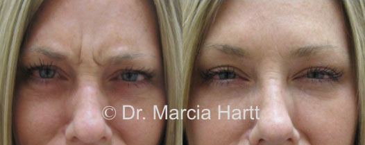 Before and after results of wrinkle removal by Dr. Marcia Hartt