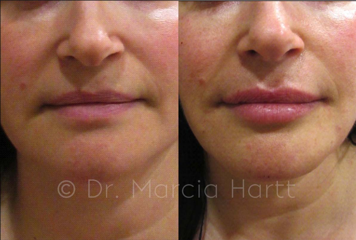Before and after photo showing results of lip injection treatment