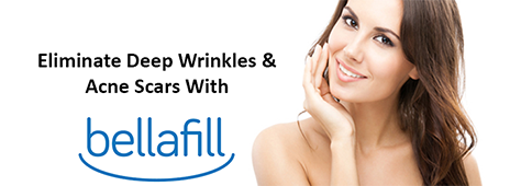 Bellafill injectable anti-aging product