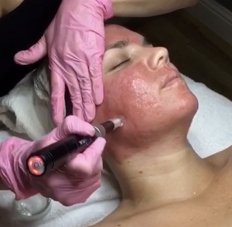 How Microneedling can Help You!