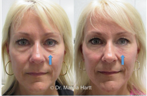 Fillers - Hips in Woburn & Dover by Age Less Weigh Less